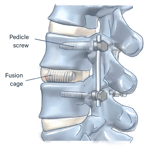 Treatment Coccyx pain  Spine and Orthopedic Specialists: NEO Surgical Group