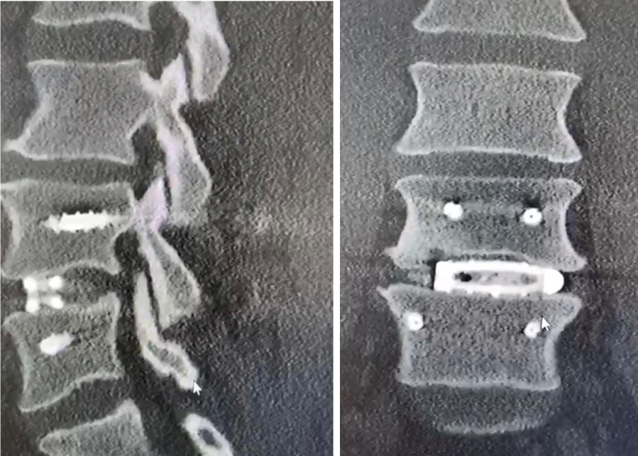 Degenerative disc disease – AEGIS Orthopaedics Pty Ltd