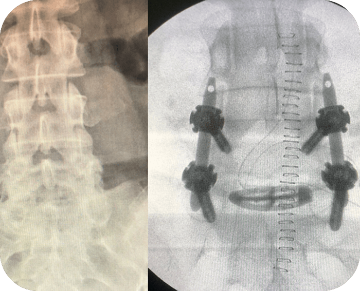 Degenerative Disc Disease L5‑S1Dr. med. Santiago Solsona Espin