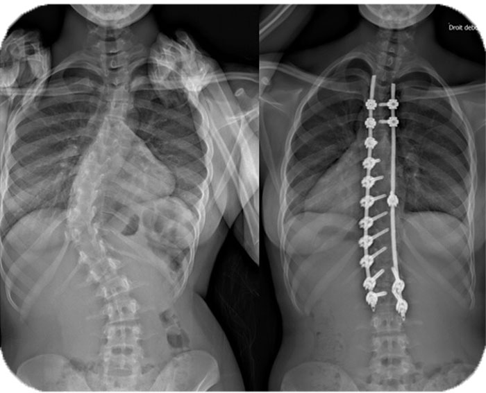 case-AdolescentIdiopathic-Scoliosis