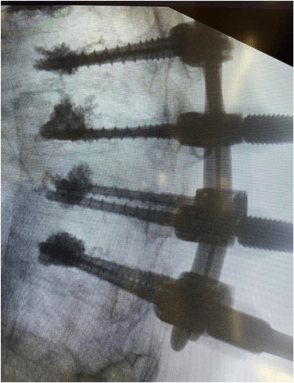 intraop14