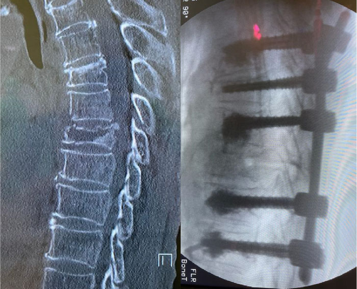 icd 10 l3 vertebral body fracture